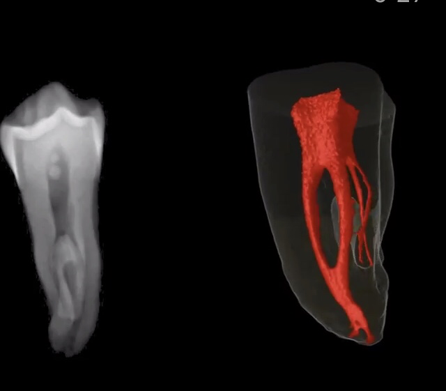 Эндодонтия. Анатомия корневых каналов 3д. Корневая система каналов зубов. Система корневых каналов зуба.